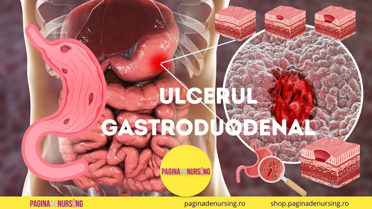 Ulcerul gastroduodenal (îngrijirea pacientului cu ulcer gastroduodenal)