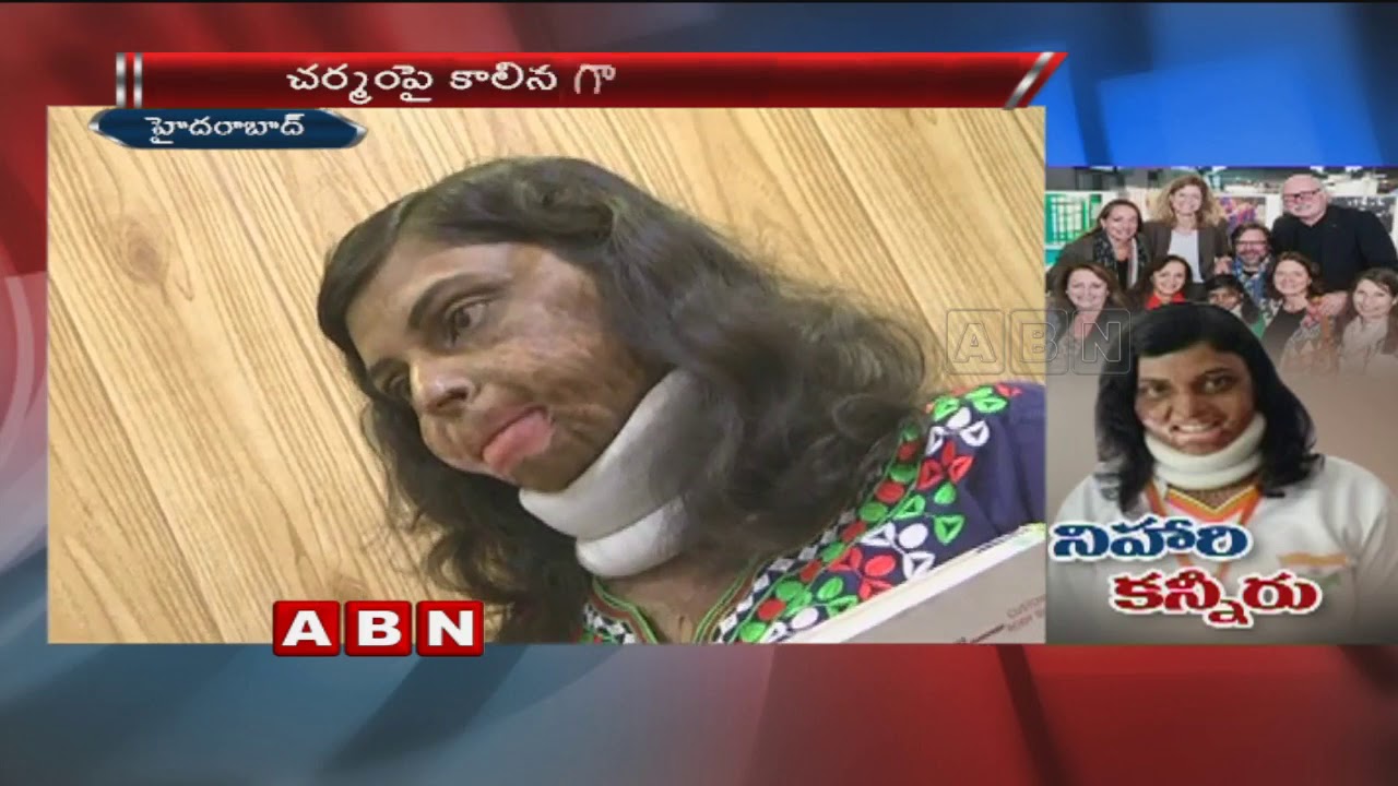 Burn survivor Nihari Mandali demands special identity
