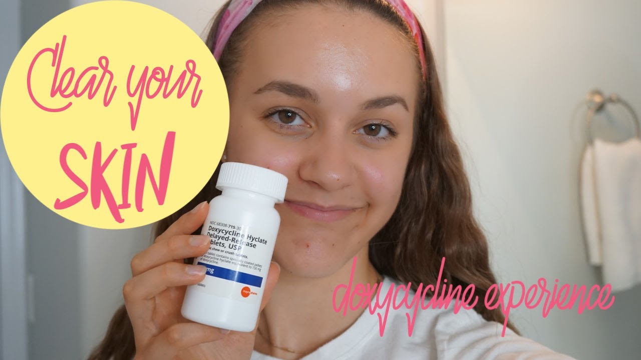 How To Get Rid of Acne / My Doxycycline Experience