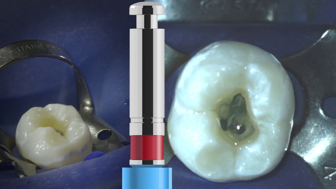 VDW Dental &middot; VDW.ROTATE&trade; Basic Sequence (clinical video)