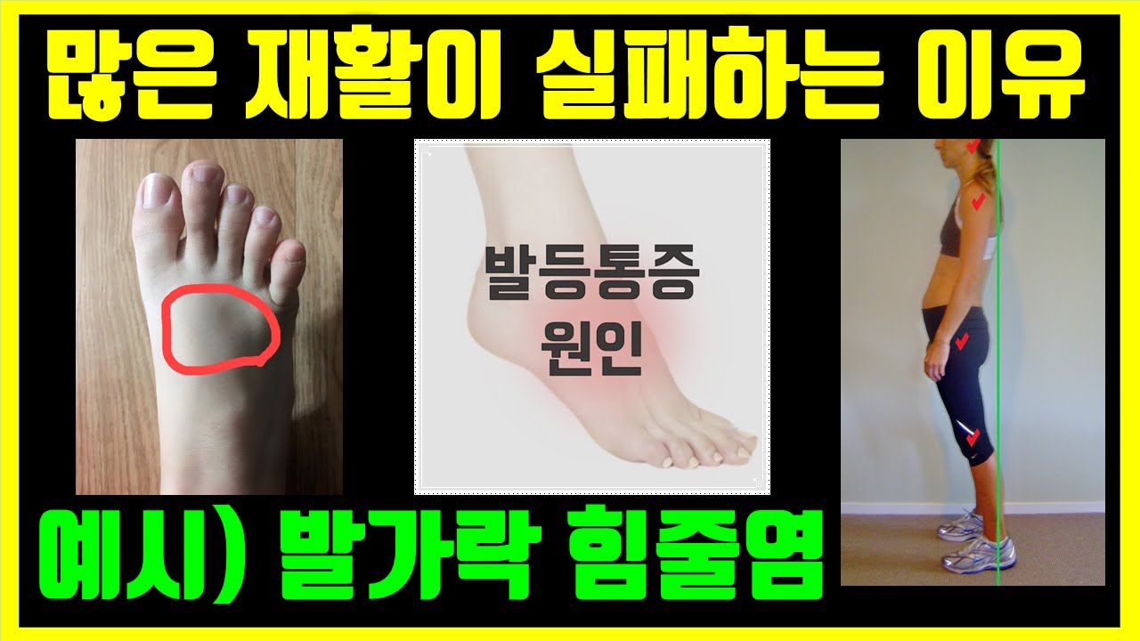 발가락 힘줄염 에도 체형교정 이 필요한 이유! 재활에 실패하는 이유!