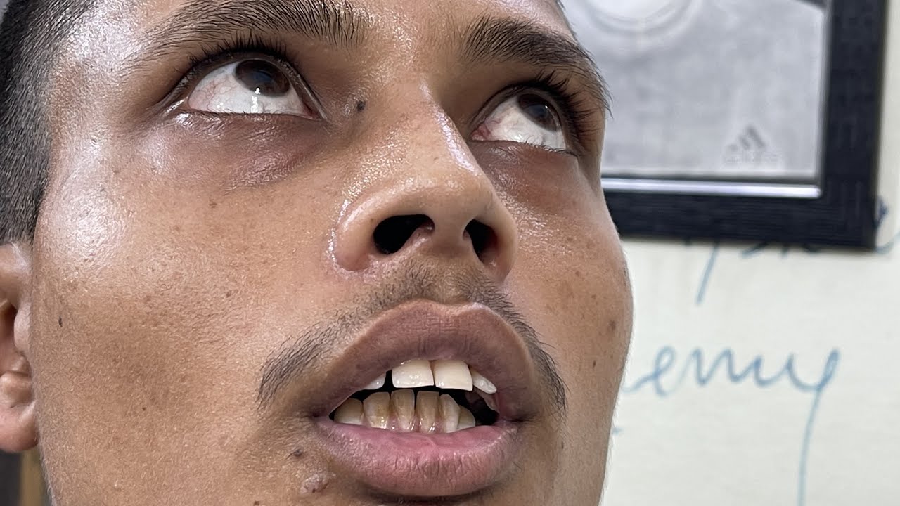#TOD #IndianArmy दाँतो का Medical Test की समस्या😭