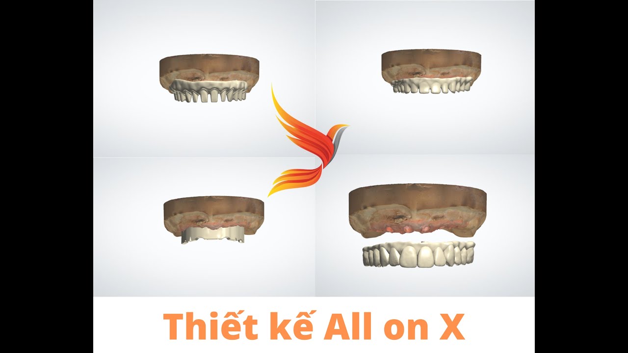 PHR-IMPLANT #6: Thiết Kế Phục Hình All on X