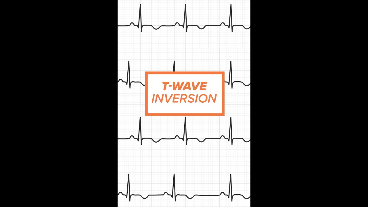 T Wave Inversion