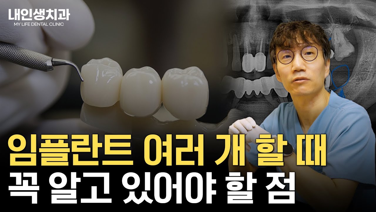 임플란트 여러 개 할 때 꼭 알고 있어야 할 점