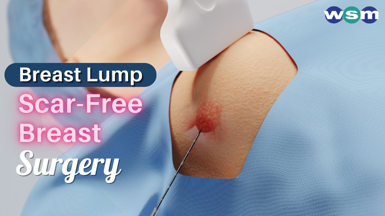 Benign Breast Lump Fibroadenoma & Breast Cyst | Scarless Breast Surgery Microwave Ablation Treatment