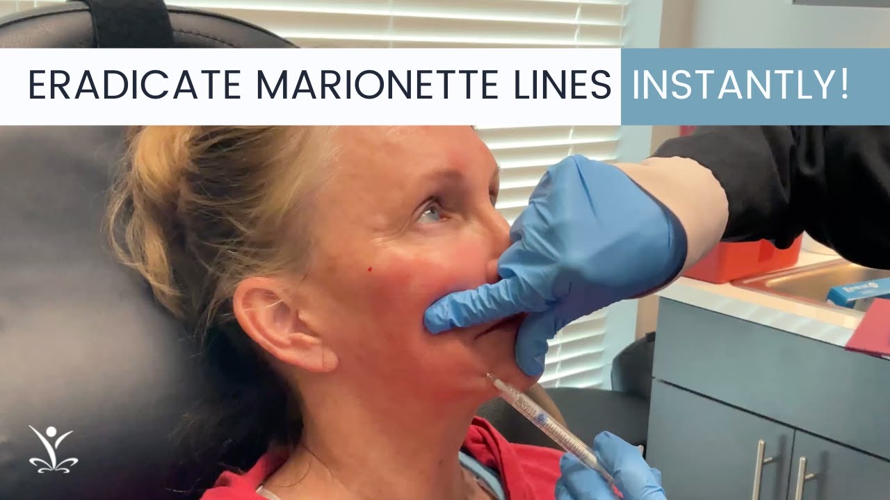 Get Instant Results with Filler for Marionette Lines!