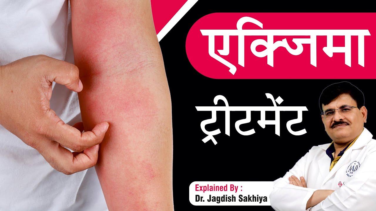 एक्जिमा ट्रीटमेंट  Treatment | How to get rid of Eczema | Sakhiya Skin Clinic | Dr Jagdish Sakhiya