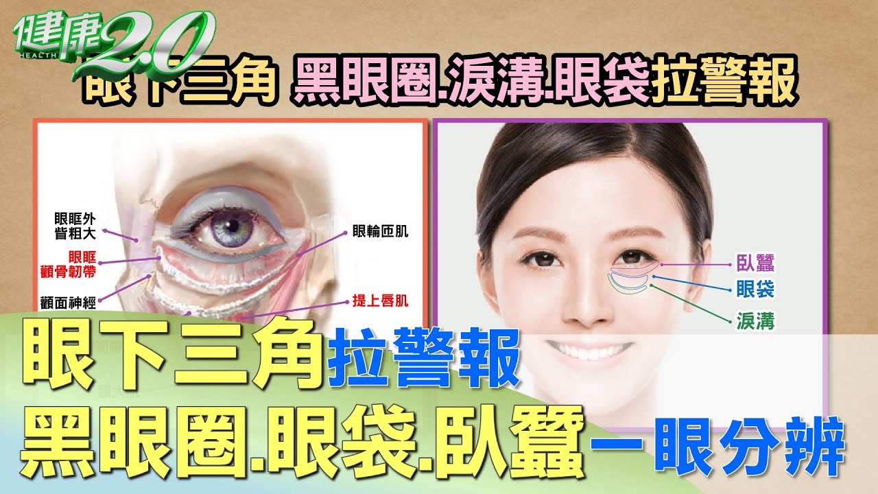 眼睛下面一坨是什麼？ 黑眼圈.眼袋.臥蠶一眼分辨 健康2.0