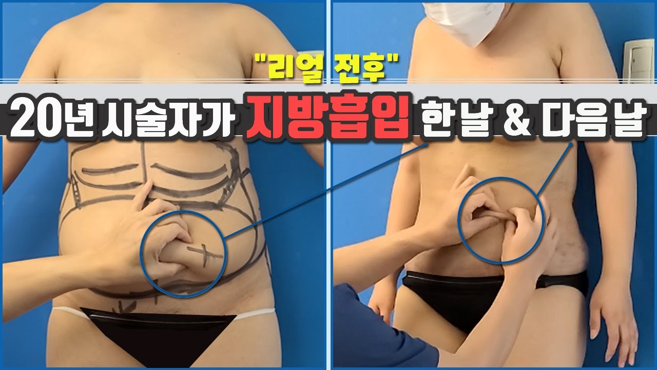 지방흡입 한날과 다음날의 리얼 후기(20년 전문의의 시술후기)