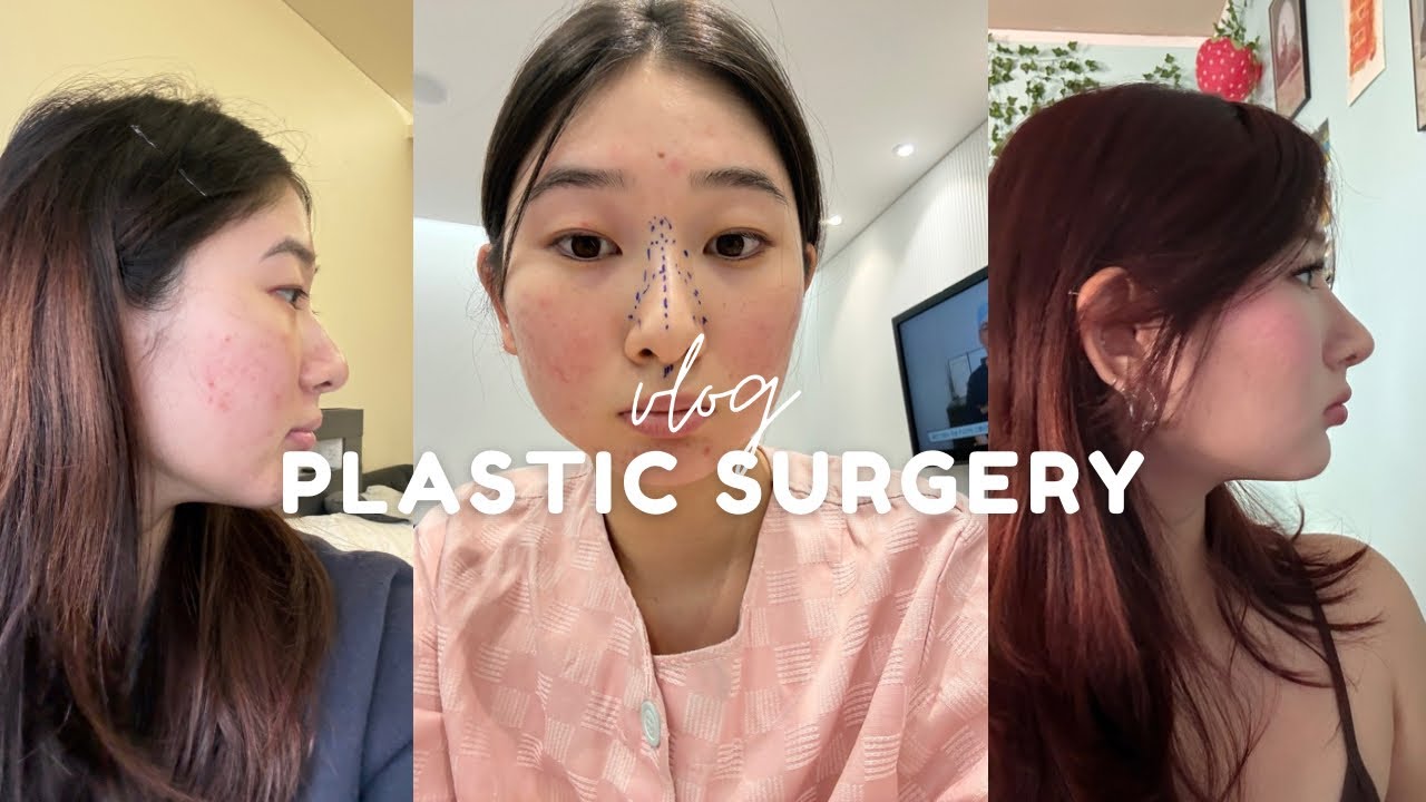 I Got a NOSE JOB IN KOREA (1 week recovery + results) | vlog