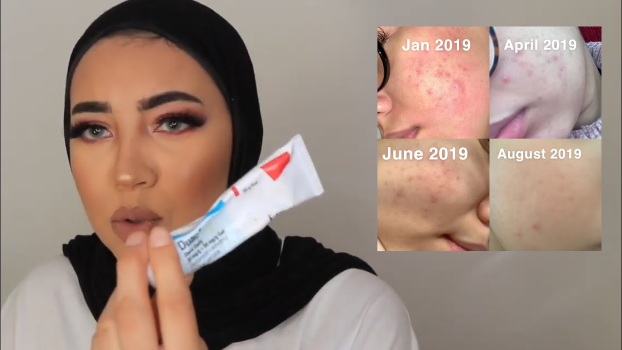 ACNE JOURNEY! Roaccutane? benzyl paroxide? PCOS? + night time skincare routine