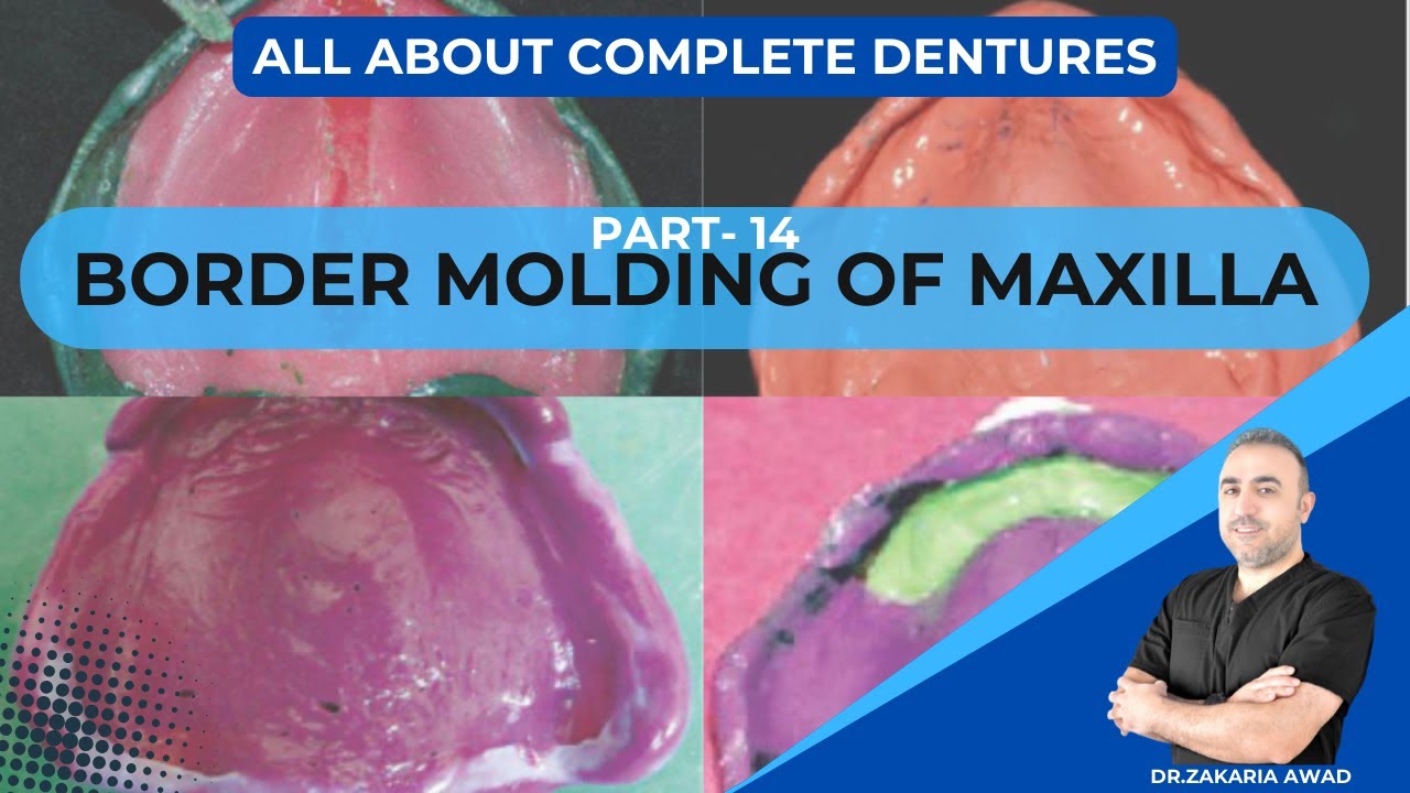 14- Maxillary Border  Molding - طبعة الحواف للفك للعلوي
