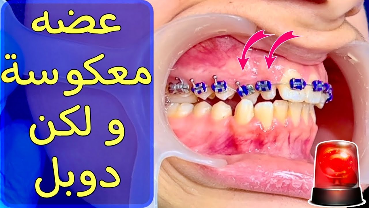 رعب العضه المعكوسة في الاسنان الامامية  #colors #happy #teeth #dentist #braces #comedy #تقويم