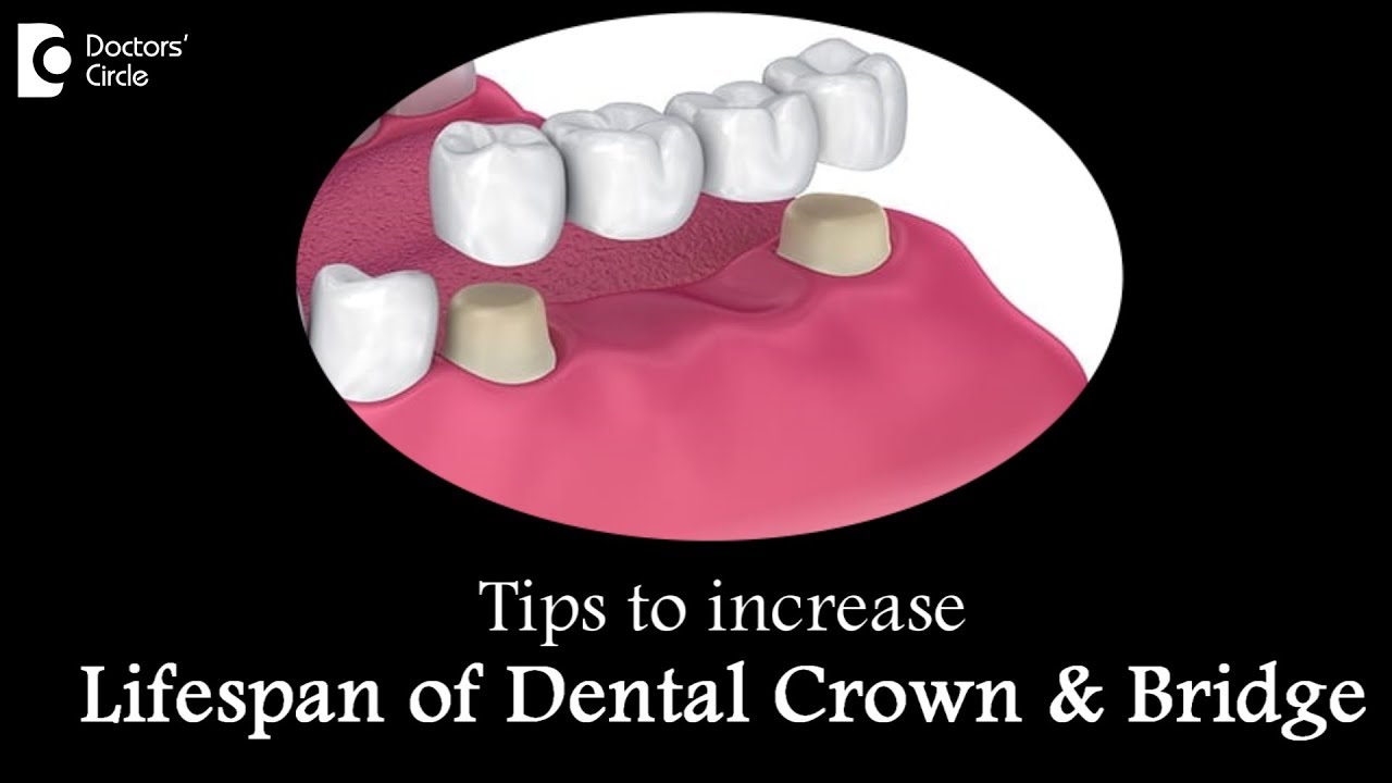 How to care for a crown and bridge? How long does it last? - Dr. Ranjani Rao