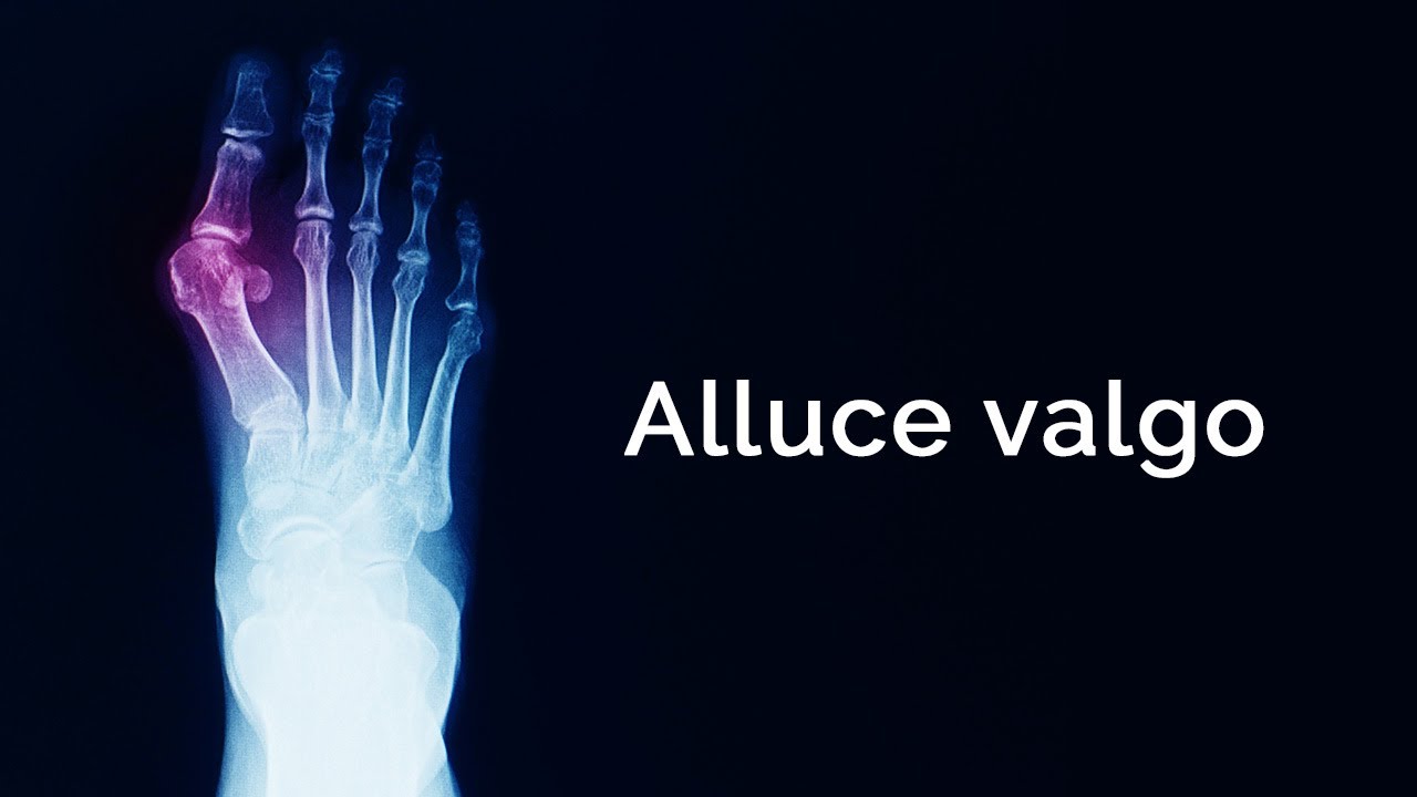 ALLUCE VALGO, cos'è e quali cure adottare