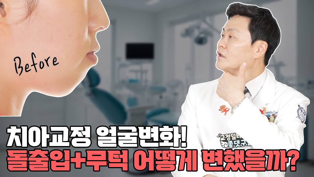 돌출입 무턱 치아 발치/비발치 교정 전후 얼굴 변화! 어떻게 변했을까? | 교정일타허원장