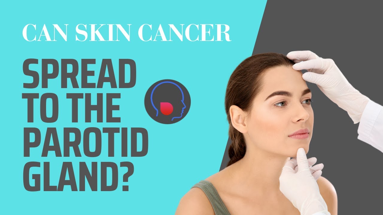 Can skin cancer spread to the parotid gland?
