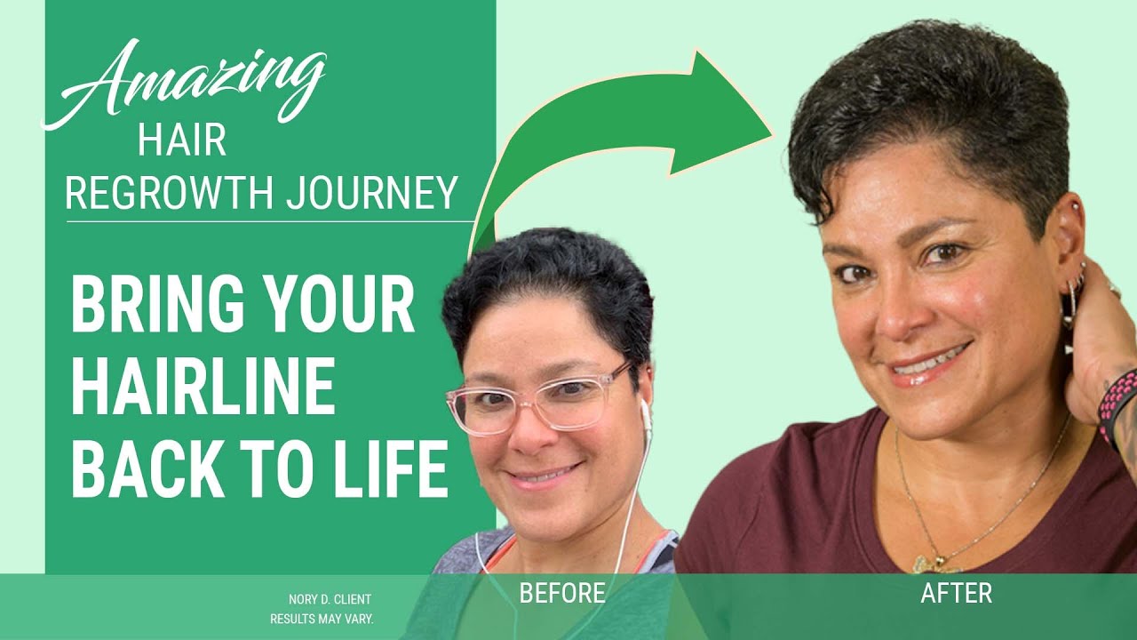 HairClub’s EXT Treatments Helped Bring Nory’s Hairline Back to Life [Hair Regrowth Option]