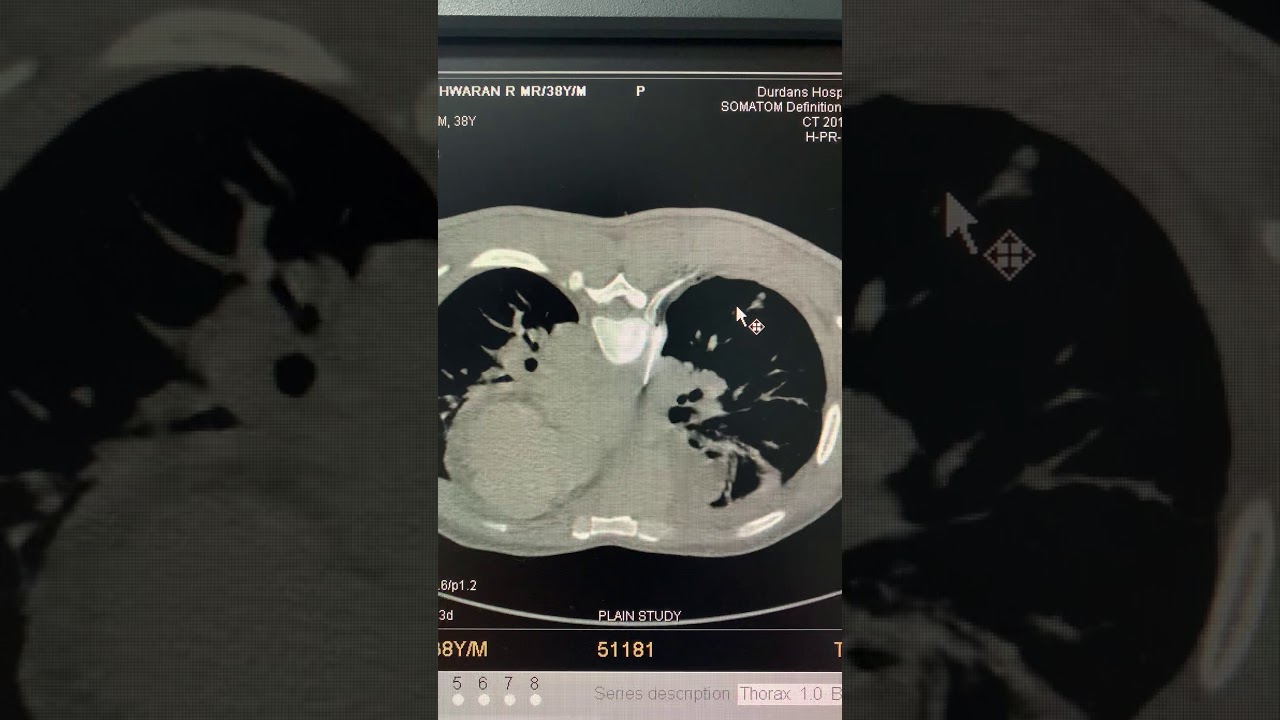 CT guided mediastinal tru cut biopsy
