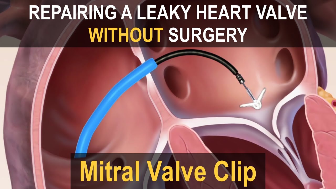 MITRAL VALVE CLIP (MitraClip/Pascal) | Repairing a Leaky Heart Valve without Surgery