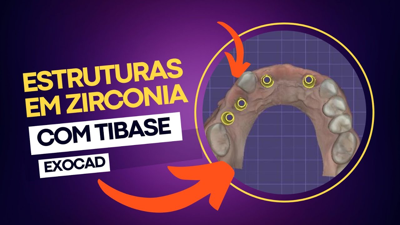 PEQUENAS ESTRUTURAS EM ZIRCÔNIA+TIBASE+MINI PILAR+EXOCAD.