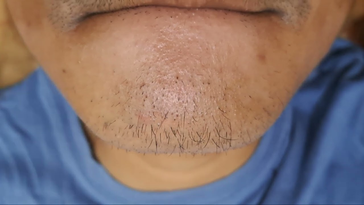 Satisfying Moment, cabut bulu dagu | #9 #hairremoval #plucking #tweezer 