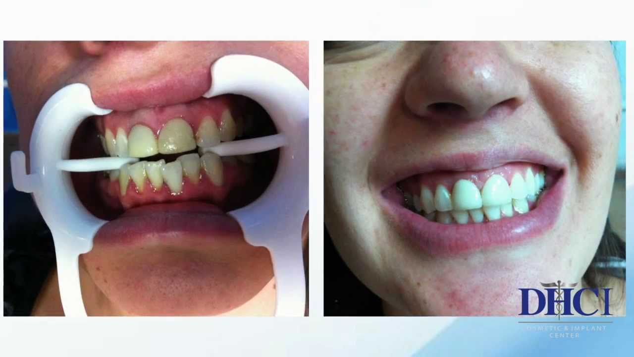 Implantes dentales en Guadalajara Jalisco. México