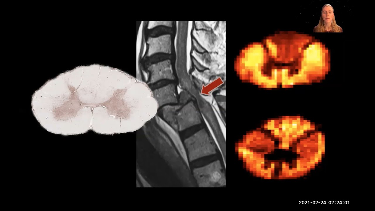 PHAS 2021 3MT: Sarah Morris (Using advanced MRI to track myelin loss after spinal cordinjury)