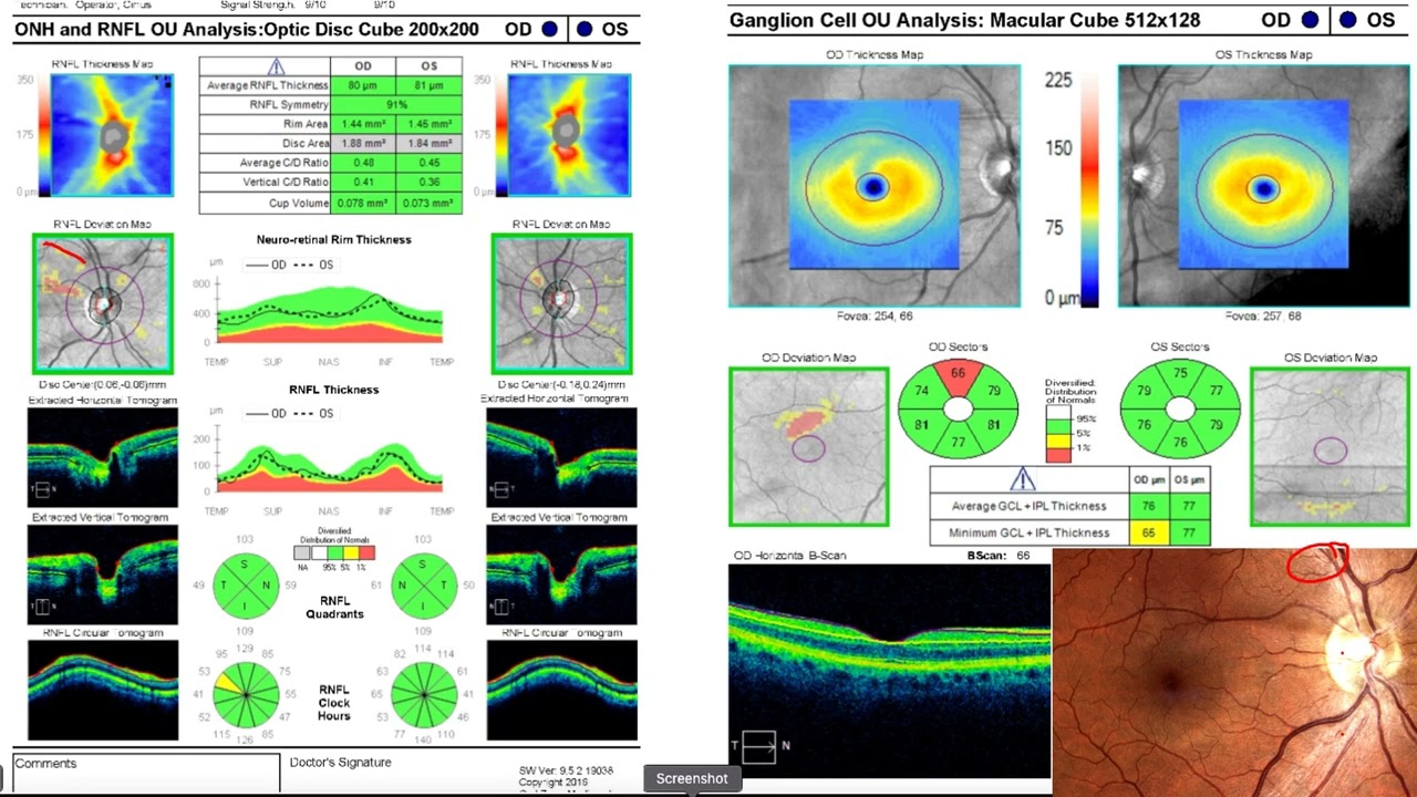 OPTICAL COHERENCE TOMOGRAPY (OCT) MACULA INTERPRETATION