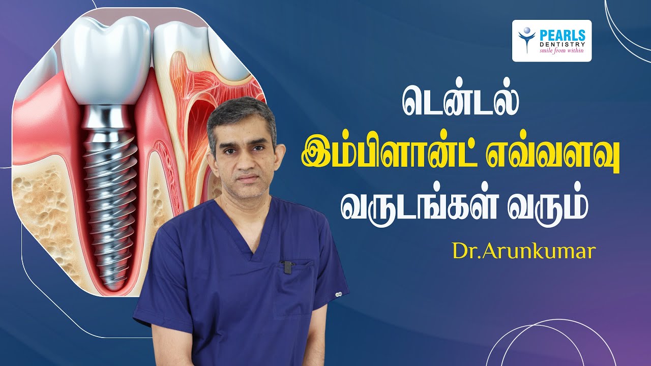 டென்டல் இம்பிளான்ட் எவ்வளவு வருடங்கள் வரும் | Pearls Dentistry | Dr.Arunkumar | Chennai