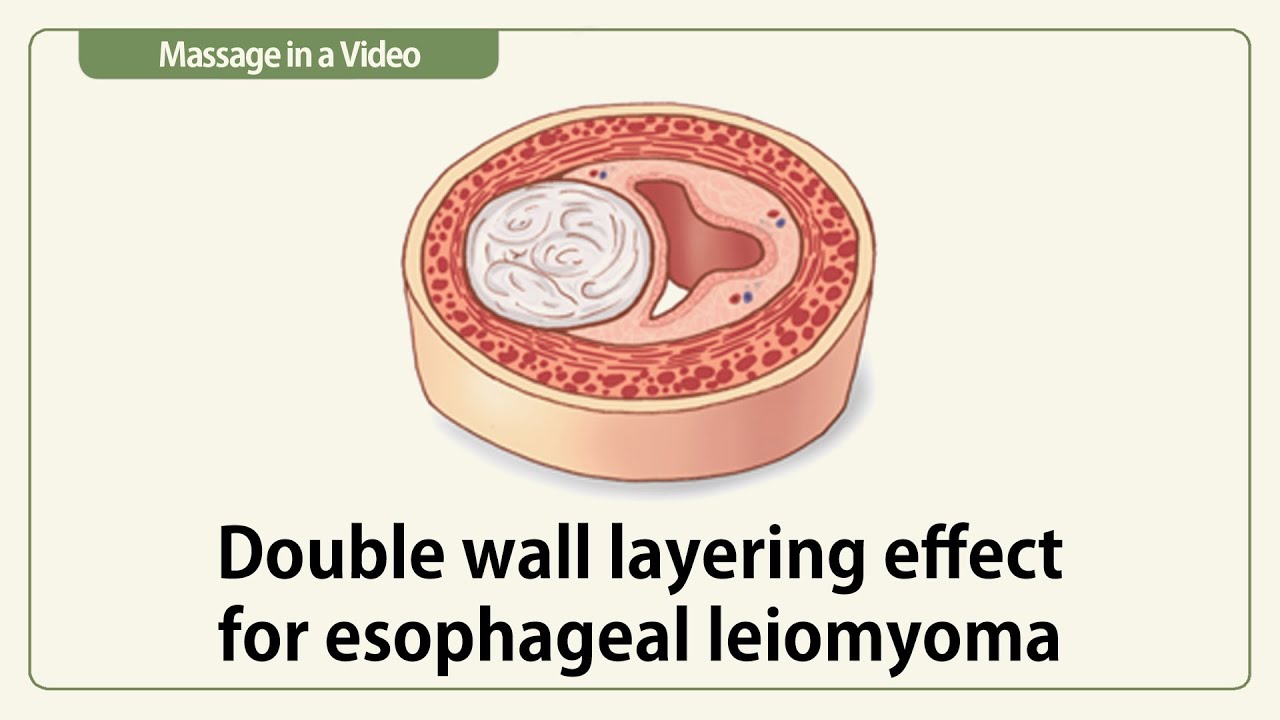 Double wall layering effect for esophageal leiomyoma