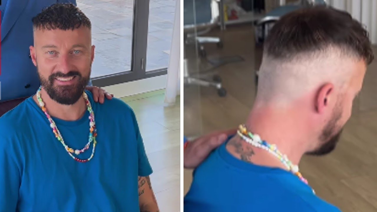 Francesco Facchinetti ha infoltito i capelli con un trapianto: ecco il risultato