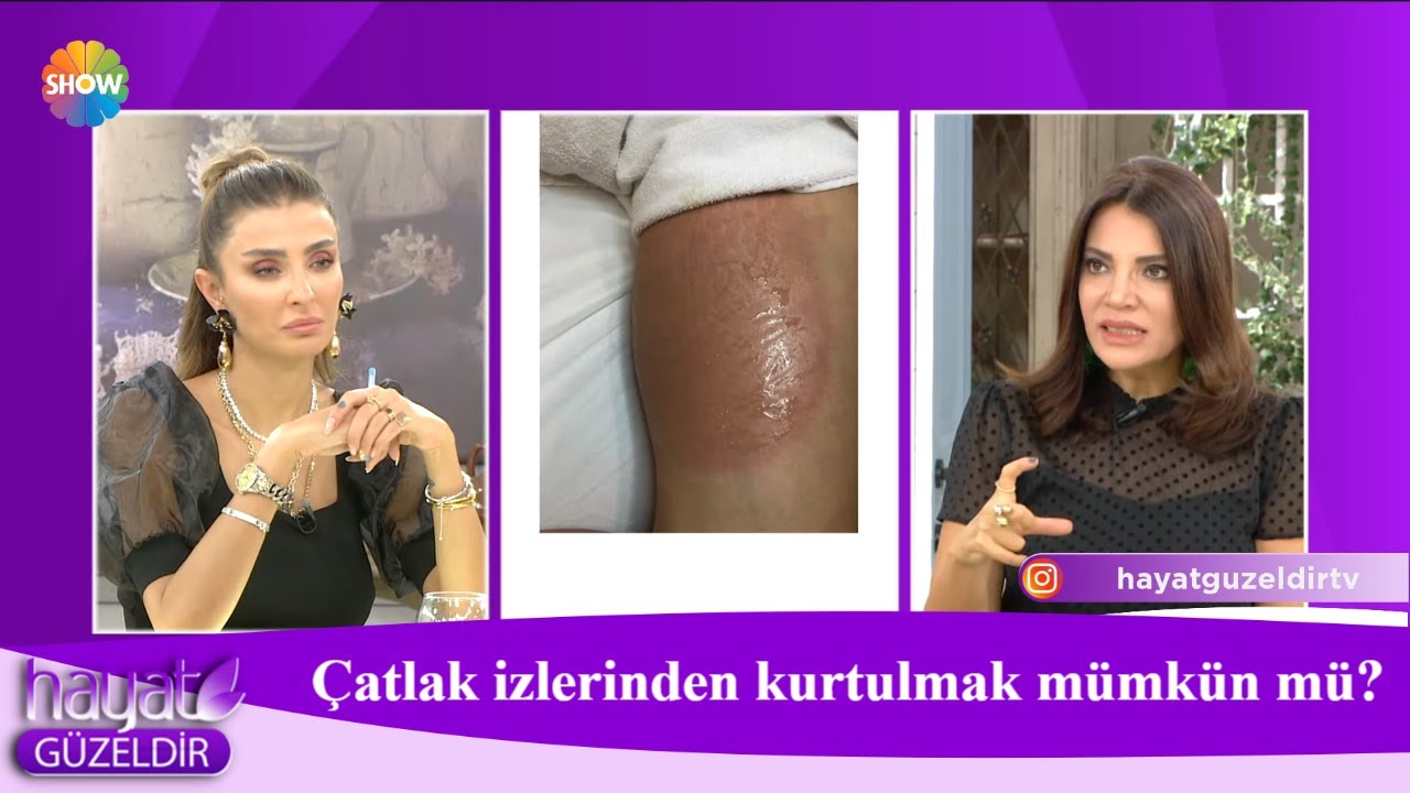 Çatlak izlerinden kurtulmak mümkün mü?