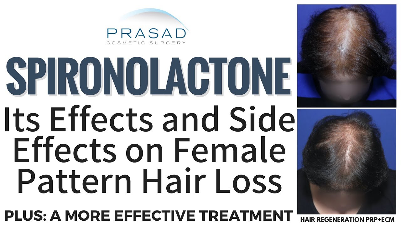 Effects of Spironolactone on Female Pattern Hair Loss and Kidneys, and a More Reliable Treatment