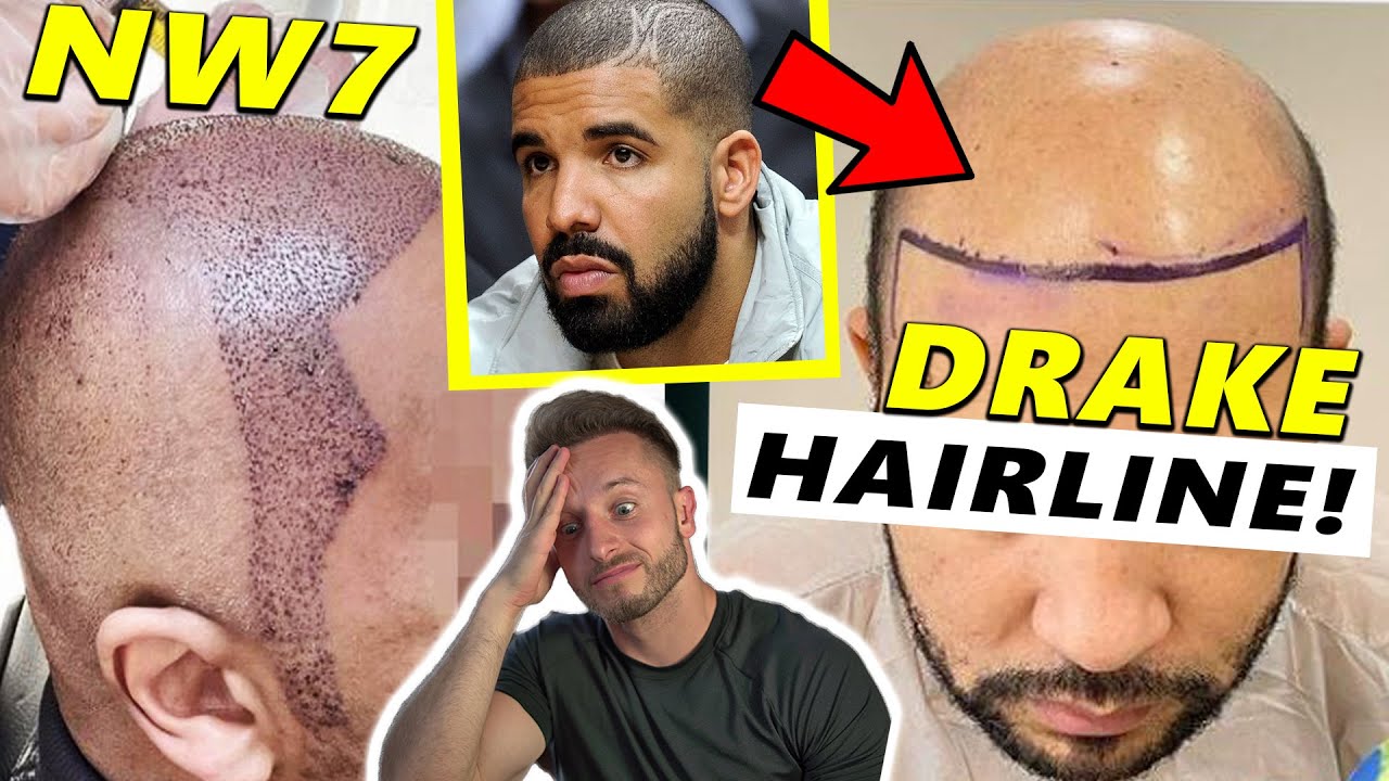 The Most Ridiculous Hair Transplant Clinic on Instagram!!!