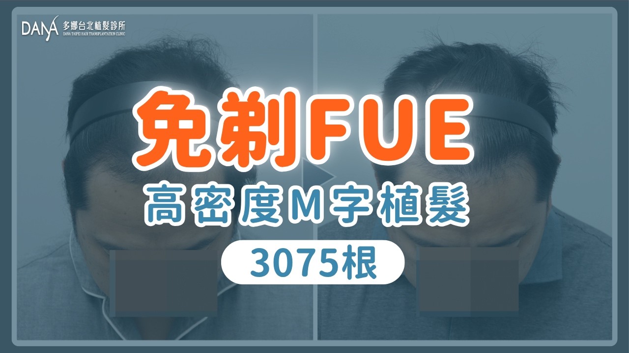【梳頭成果呈現】免剃FUE | 高密度M型植髮篇