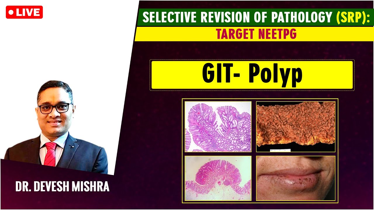 Selective Revision of Pathology (#SRP): Target  NEETPG: GIT-Polyp by Devesh Mishra.
