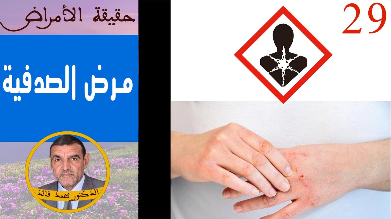 حقيقة مرض الصدفية | الدكتور محمد فائد
