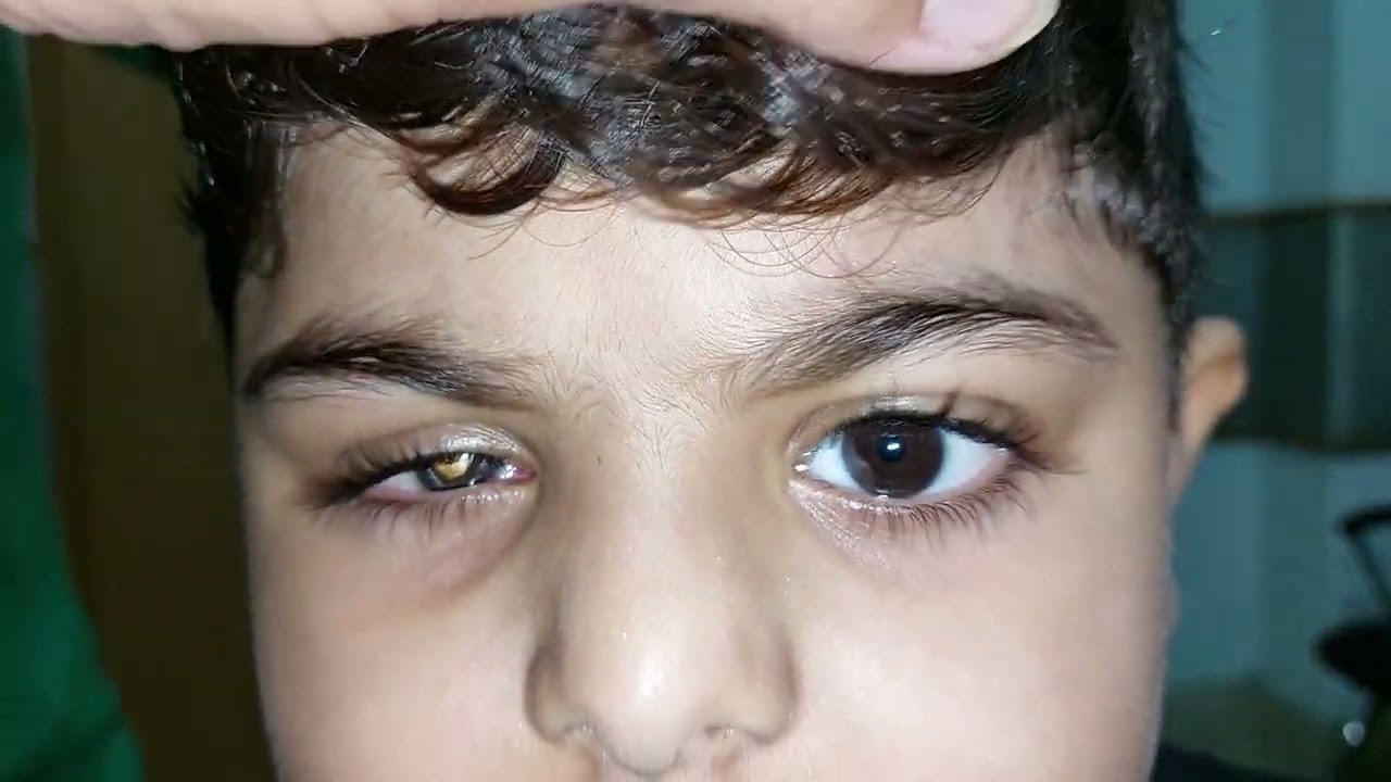 Phthisis eye requiring evisceration