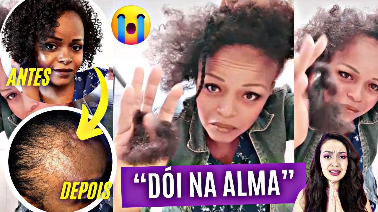 CAIU TODO O CABELO E ATROFIOU O COURO CABELUDO! ELA SE ARREPENDEU DE NÃO ACEITAR O CRESPO😭