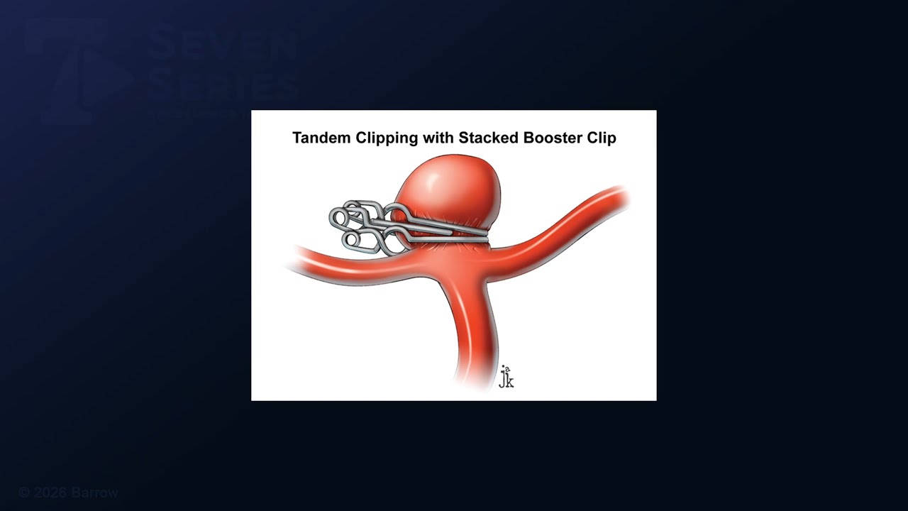 Minipterional Craniotomy for Clipping of a Calcified Middle Cerebral Artery Aneurysm