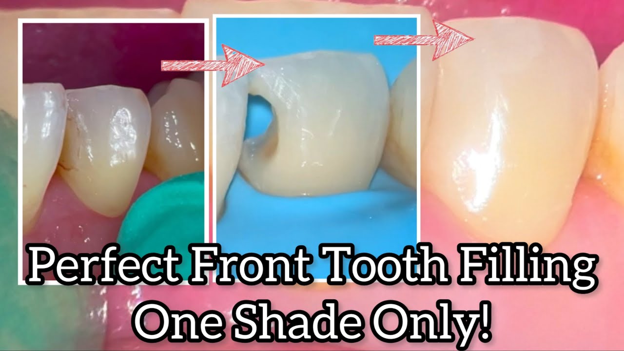 Anterior Composite Restoration with One Shade Step By Step