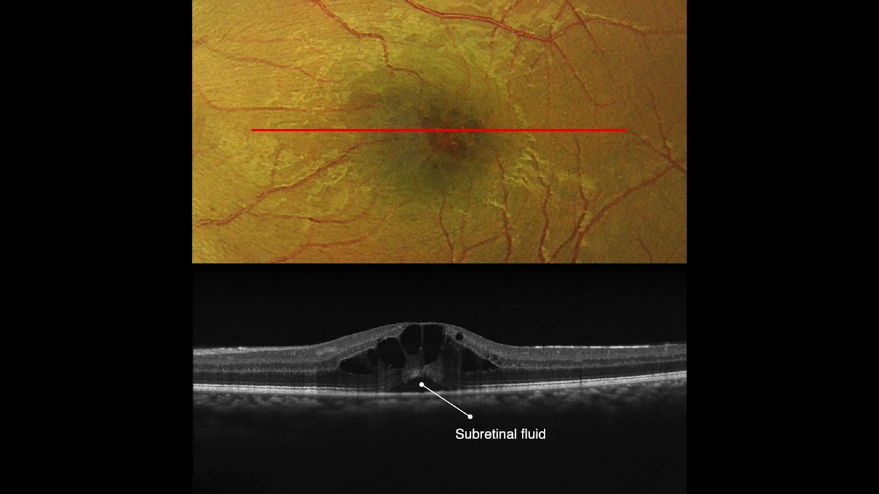 Cystoid Macular Edema in Pars Planitis, OCT Interpretation