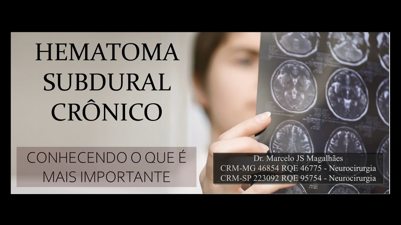 HEMATOMA SUBDURAL CRÔNICO - TUDO O QUE VOCÊ DEVE SABER - DR. Marcelo José da Silva de Magalhães