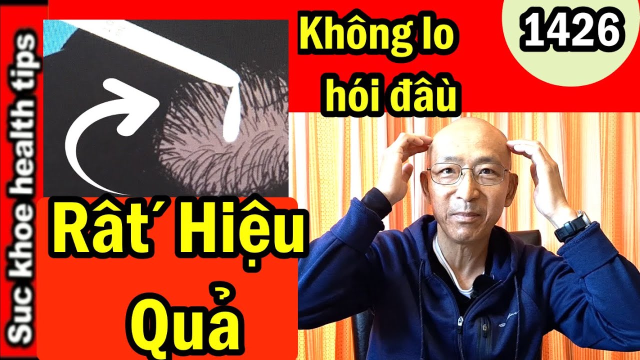 Hiệu quả không lo hói đầu thuốc mọc tóc kết quả mua ở Costco, #1426