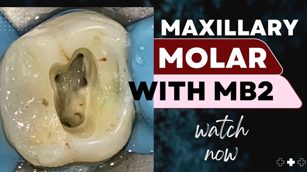 Maxillary Molar with MB2
