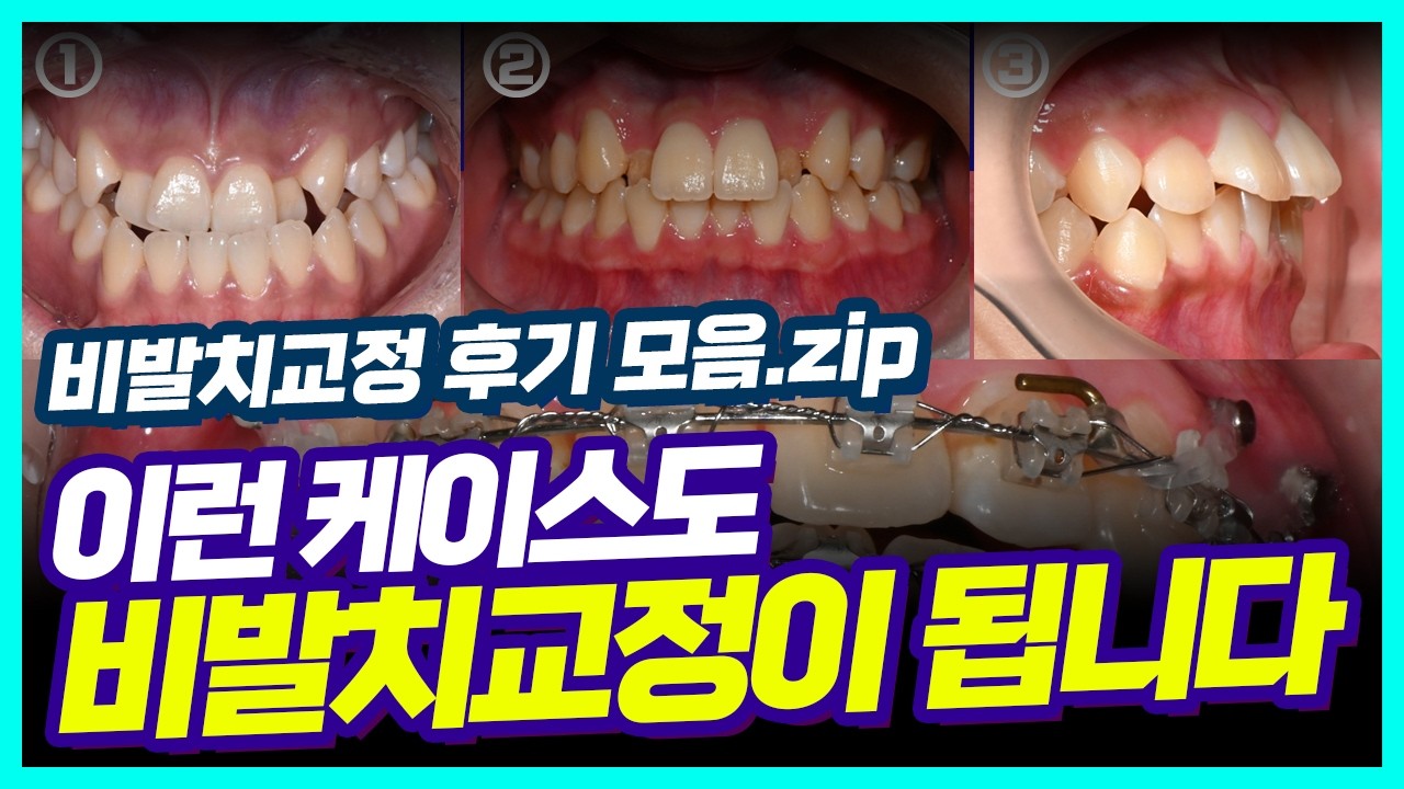 비발치교정 치료가 가능한 조건과 발치교정으로 하면 좋은 케이스 (#dentist #orthodontics #비발치교정 #교정전후)