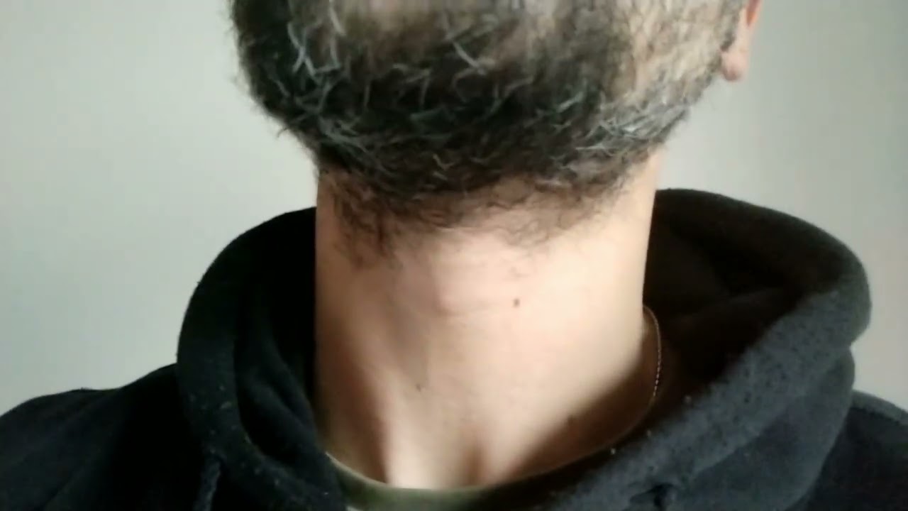 Patchy Beard 3 months growth (33 yo)