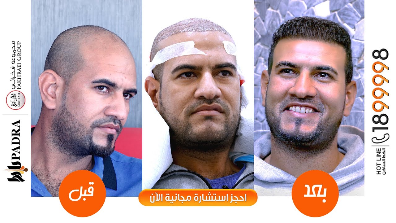 أحد عملاء بادرا كلينك و تجربته مع زراعة الشعر